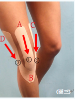 圖三: 肌肉運動貼布之膝部貼法