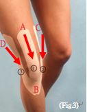 Figure 3: taping method for knee
